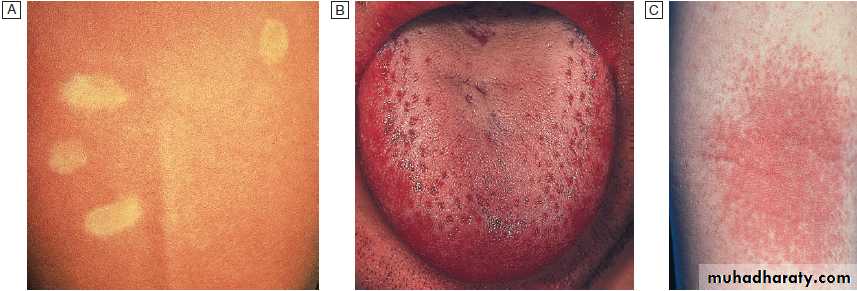 Infectious disease