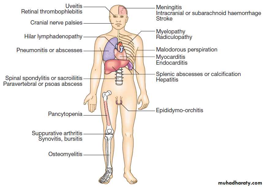 Infectious disease
