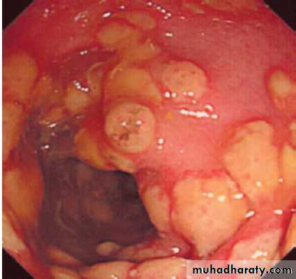 Infectious disease