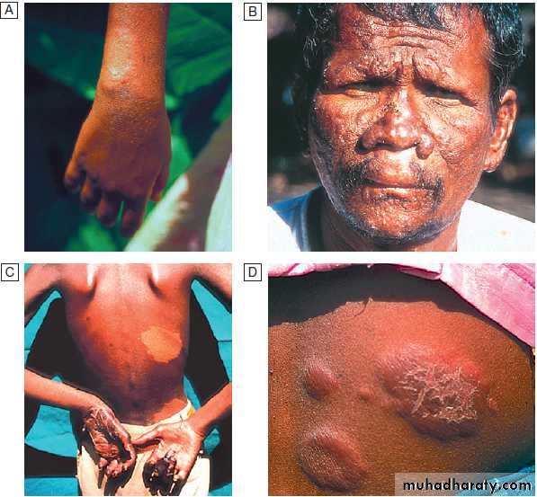 Infectious disease