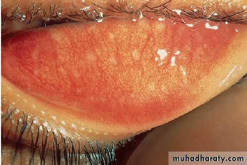 Infectious disease