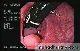 The rectum
