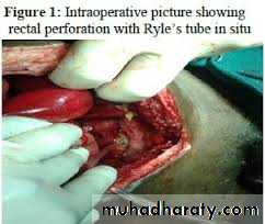 The rectum