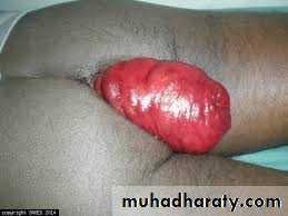 The rectum