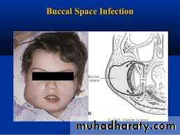Fascial spaces