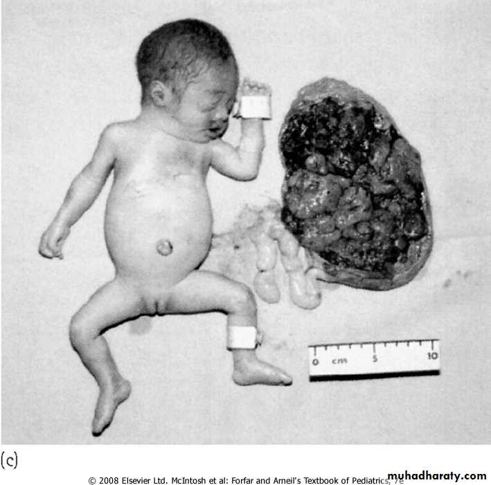 thalassemia