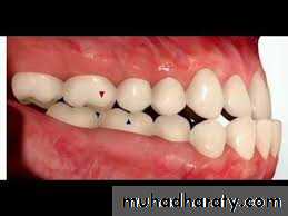 cl III malocclusion