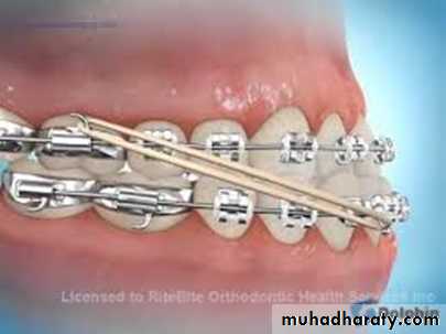 cl III malocclusion