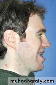 cl III malocclusion