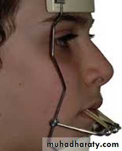 cl III malocclusion