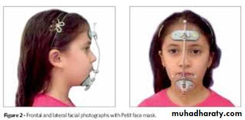 cl III malocclusion