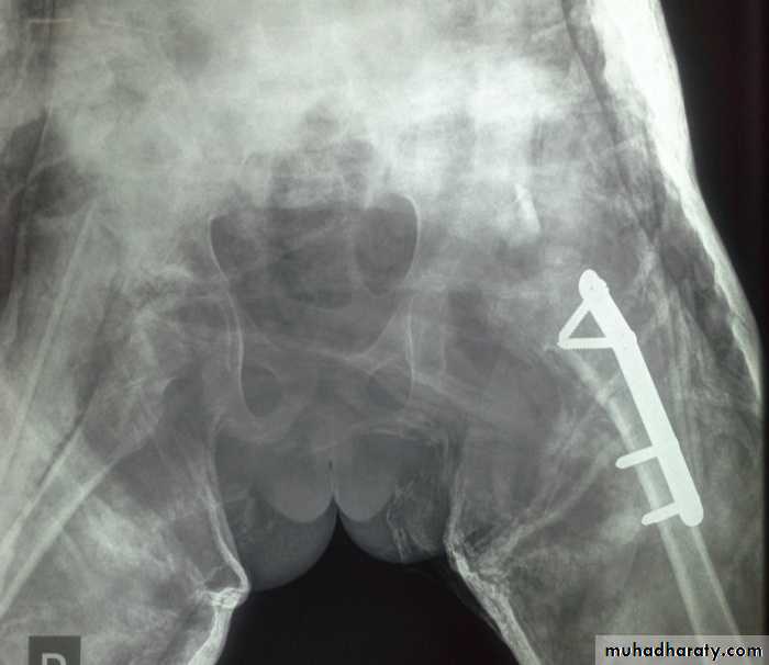 Developmental dysplasia of the hip