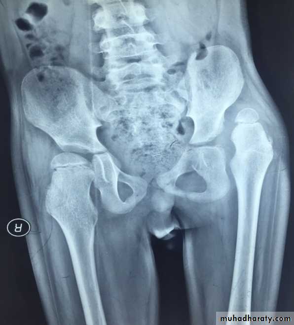 Developmental dysplasia of the hip
