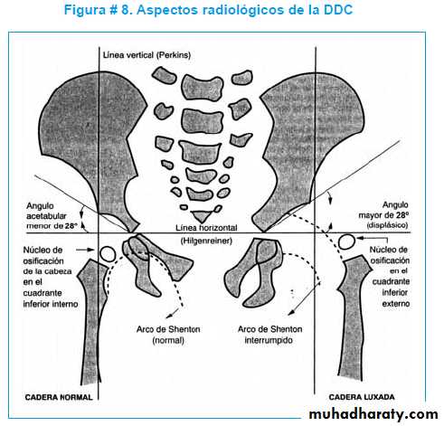 Developmental dysplasia of the hip