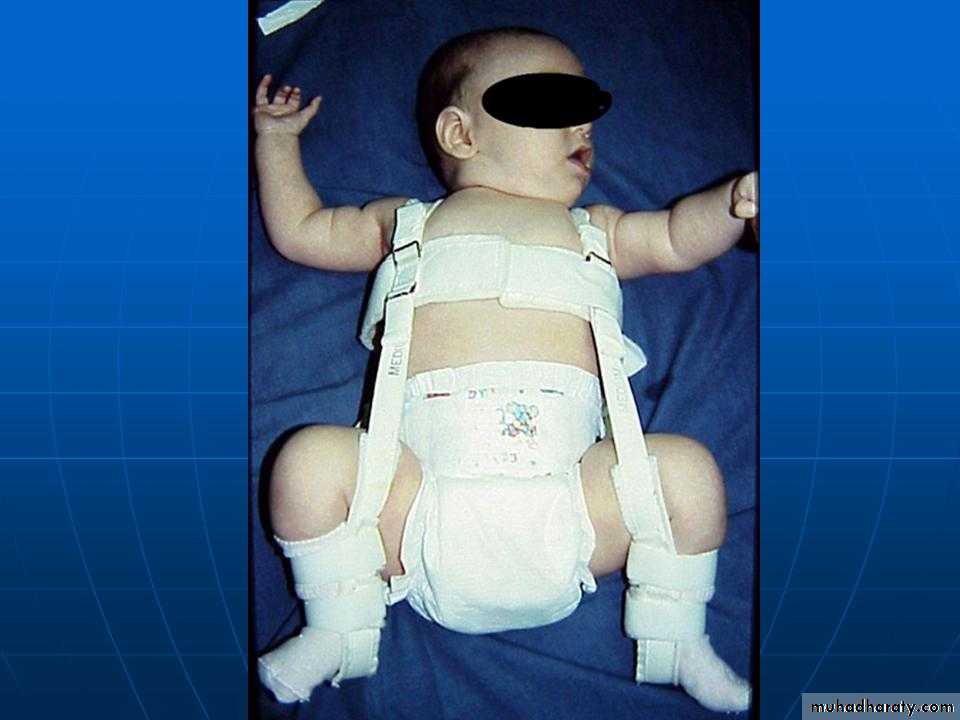 Developmental dysplasia of the hip