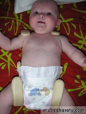 Developmental dysplasia of the hip