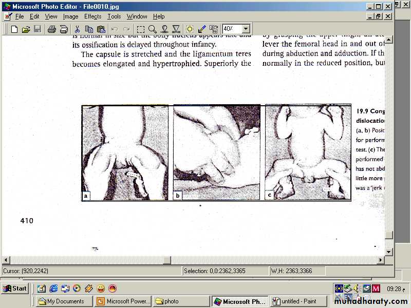 Developmental dysplasia of the hip