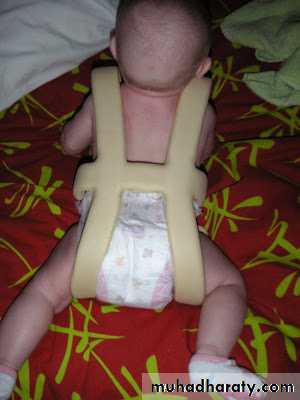 Developmental dysplasia of the hip