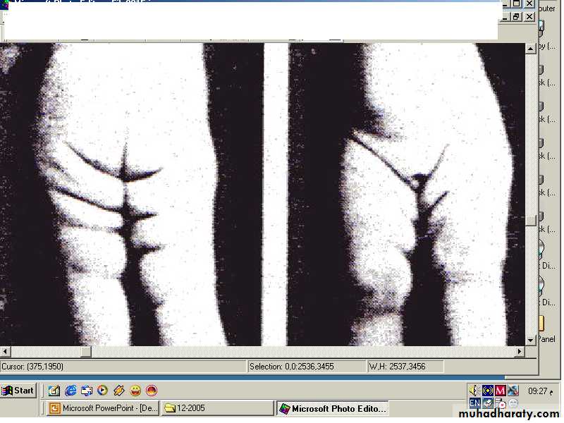 Developmental dysplasia of the hip