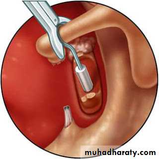 Middle Ear