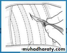 Chest surgery