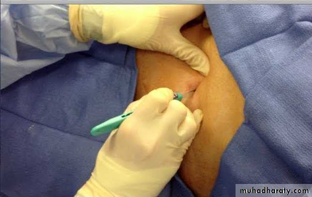 Chest surgery