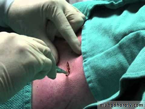 Chest surgery