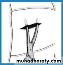 Chest surgery