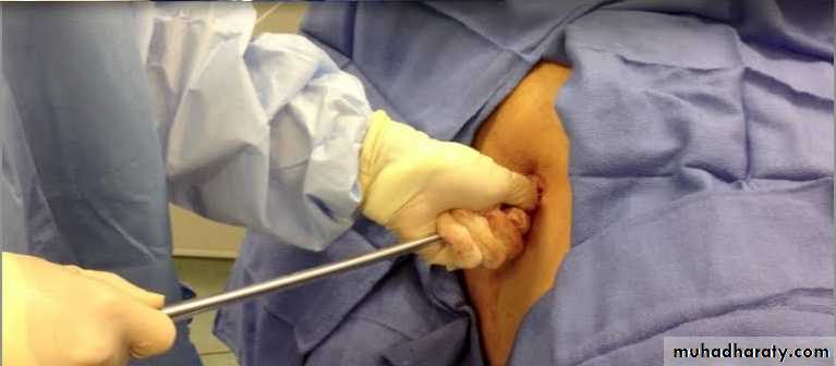 Chest surgery