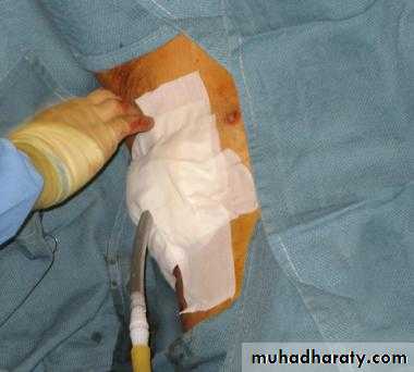 Chest surgery