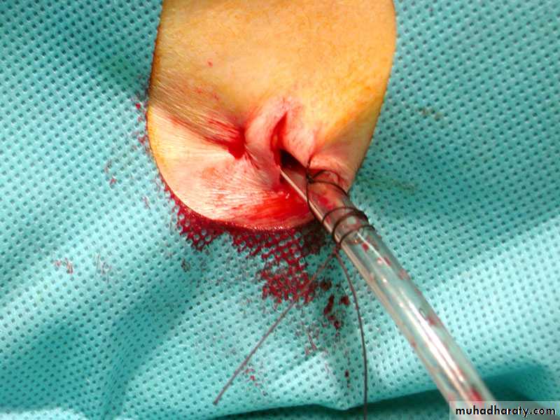 Chest surgery