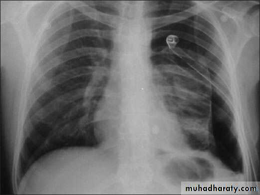 Chest surgery