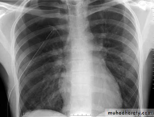 Chest surgery