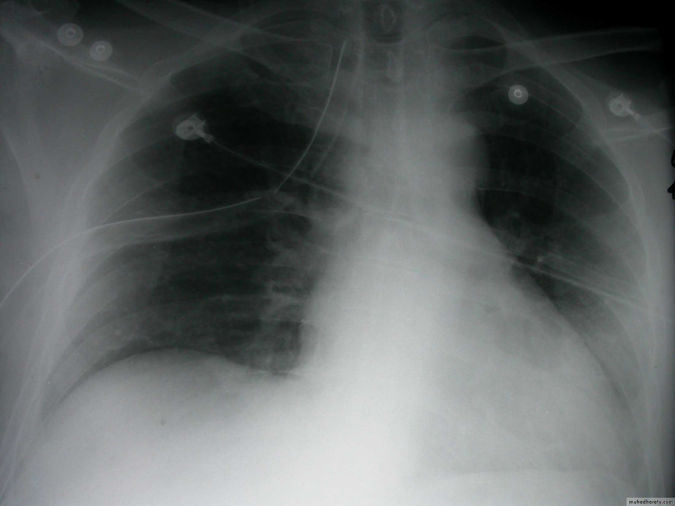 Chest surgery