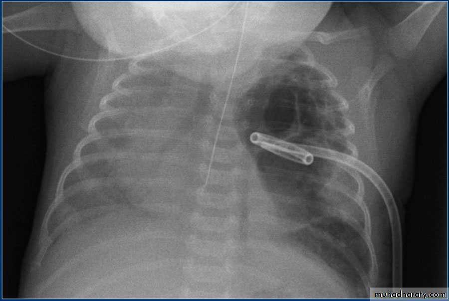 Chest surgery