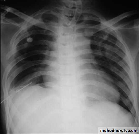 Chest surgery