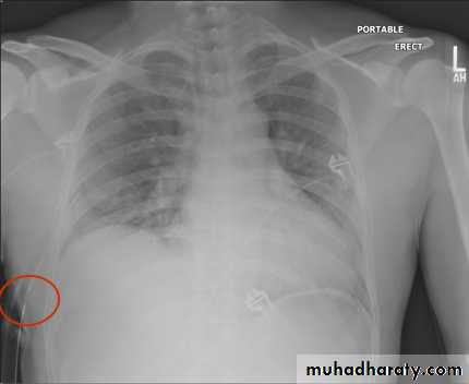 Chest surgery