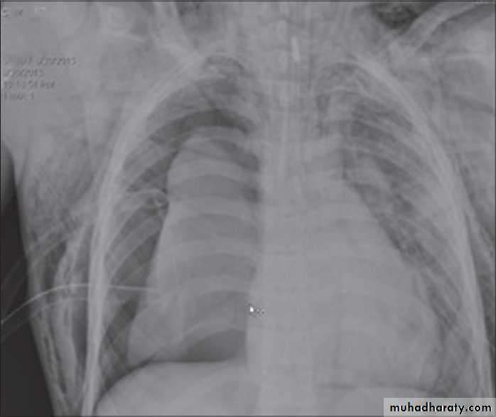 Chest surgery