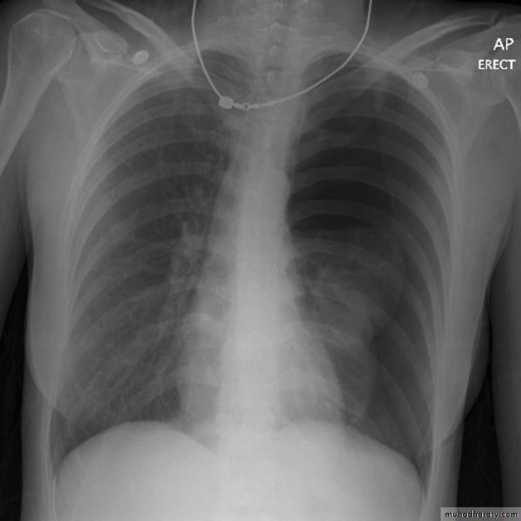 Chest surgery
