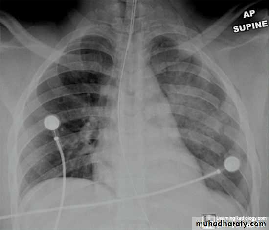Chest surgery