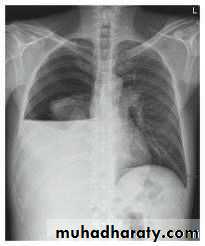 Chest surgery