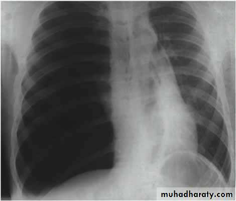Chest surgery