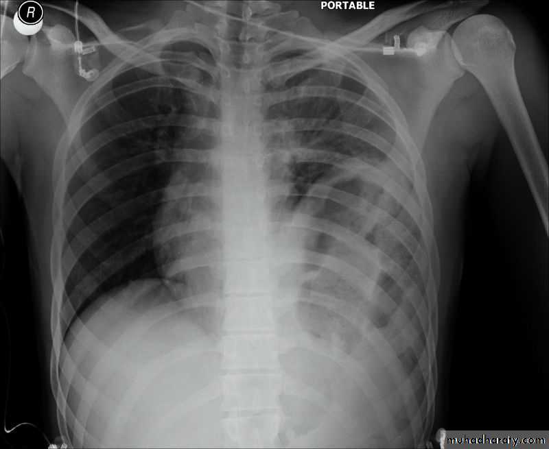Chest surgery