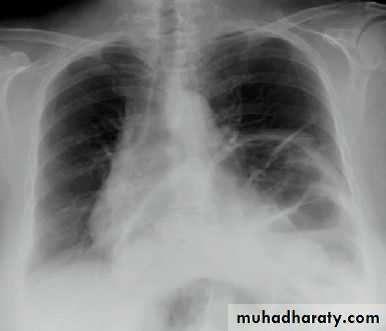 Chest surgery
