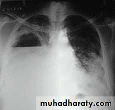 Chest surgery