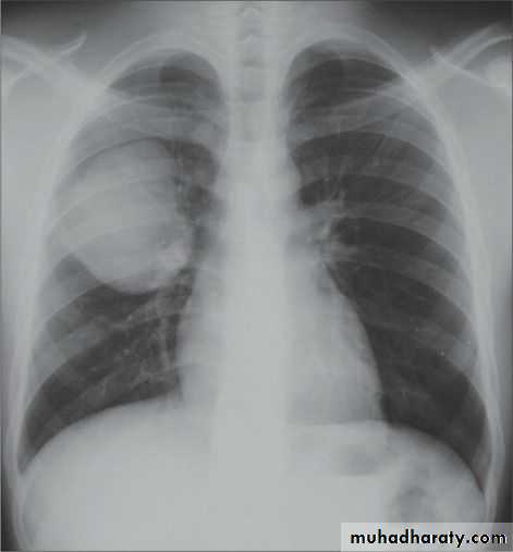 Chest surgery