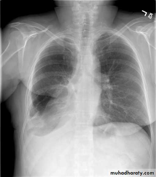 Chest surgery