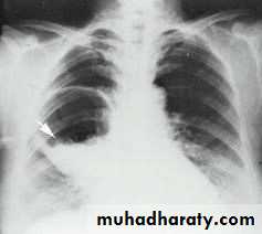 Chest surgery