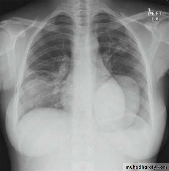 Chest surgery