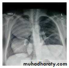 Chest surgery